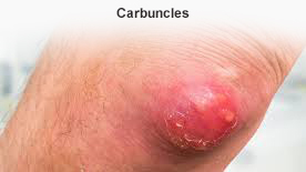 carbuncles doctor in ahmedabad