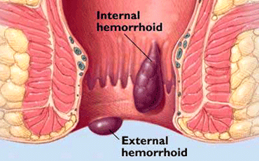 Best Piles Doctor in Ahmedabad, Gujarat, Rajasthan